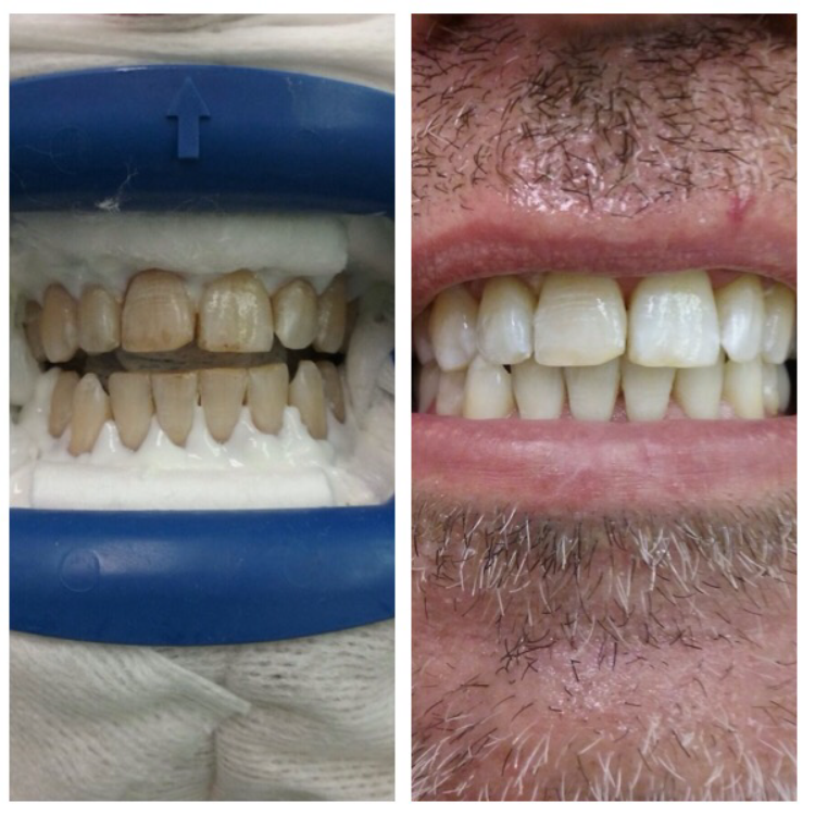 In office whitening cases 